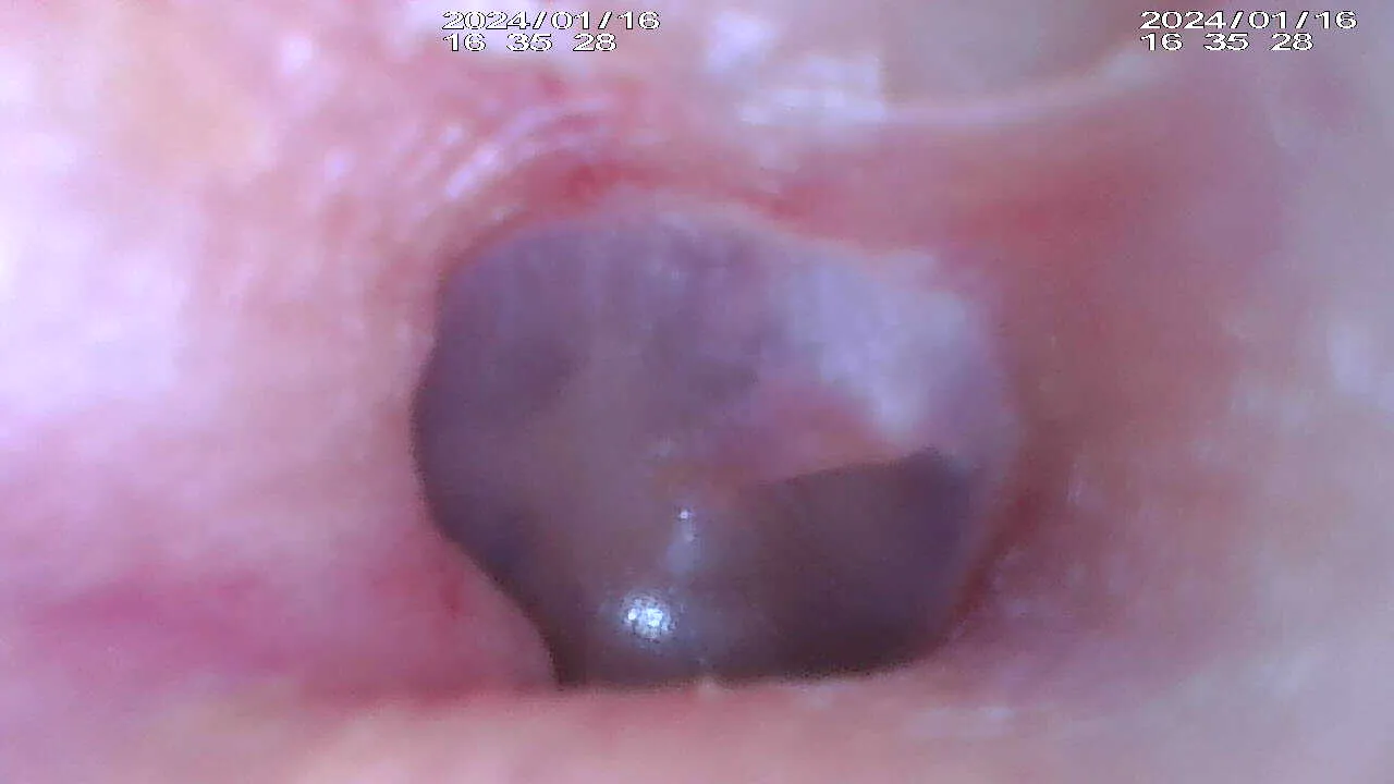 Endoscopy